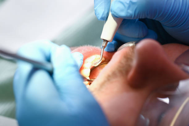 Best Emergency Wisdom Tooth Extraction in Poteet, TX